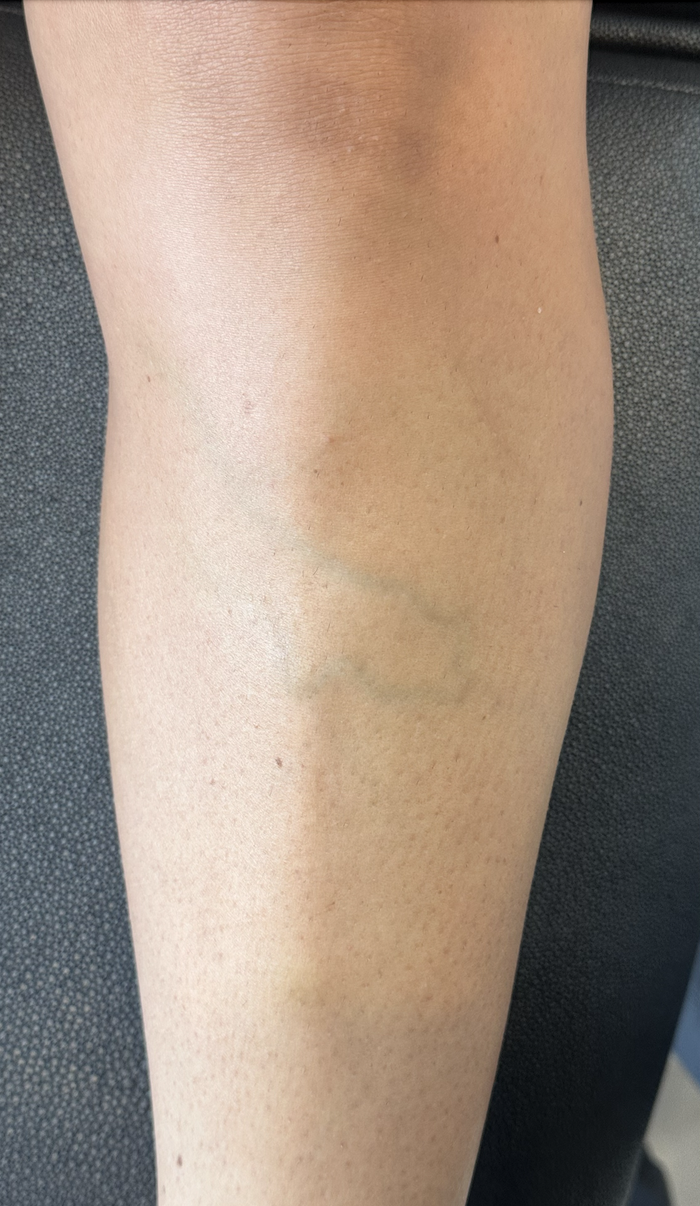 Varicose vein and reticular vein treatment result at Santa Monica Vein Center by Dr. Raffy Karamanoukian board-certified vein and plastic surgeon at Kare Plastic Surgery demonstrating successful sclerotherapy and vein treatment outcome in lower leg with resolution of visible varicose and reticular veins