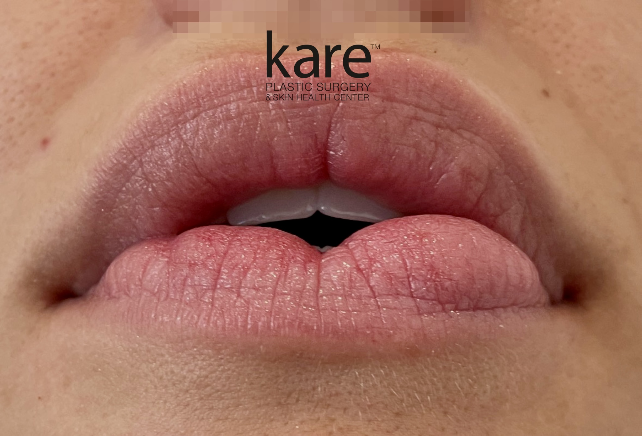Lip filler migration showing excess and maldistributed hyaluronic acid filler in the lips of a patient at Kare Plastic Surgery Los Angeles, requiring ultrasound guided hyaluronidase dissolution by Dr. Raffy Karamanoukian