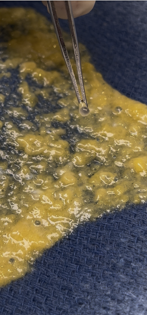 Intraoperative view of silicone biopolymer material removed from a patient at Kare Plastic Surgery Los Angeles by Dr. Raffy Karamanoukian, showing yellow granulomatous tissue and silicone particles mixed with inflammatory reaction products during open surgical excision