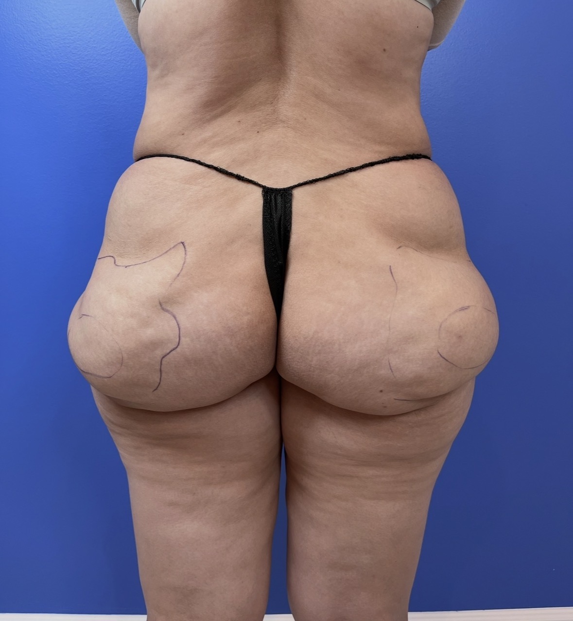 BBL reversal pre-operative surgical markings at Kare Plastic Surgery Los Angeles by Dr. Raffy Karamanoukian board-certified plastic surgeon showing detailed lipo-contouring surgical planning for reverse Brazilian butt lift fat removal and buttock volume reduction with precise zone mapping on posterior view of patient