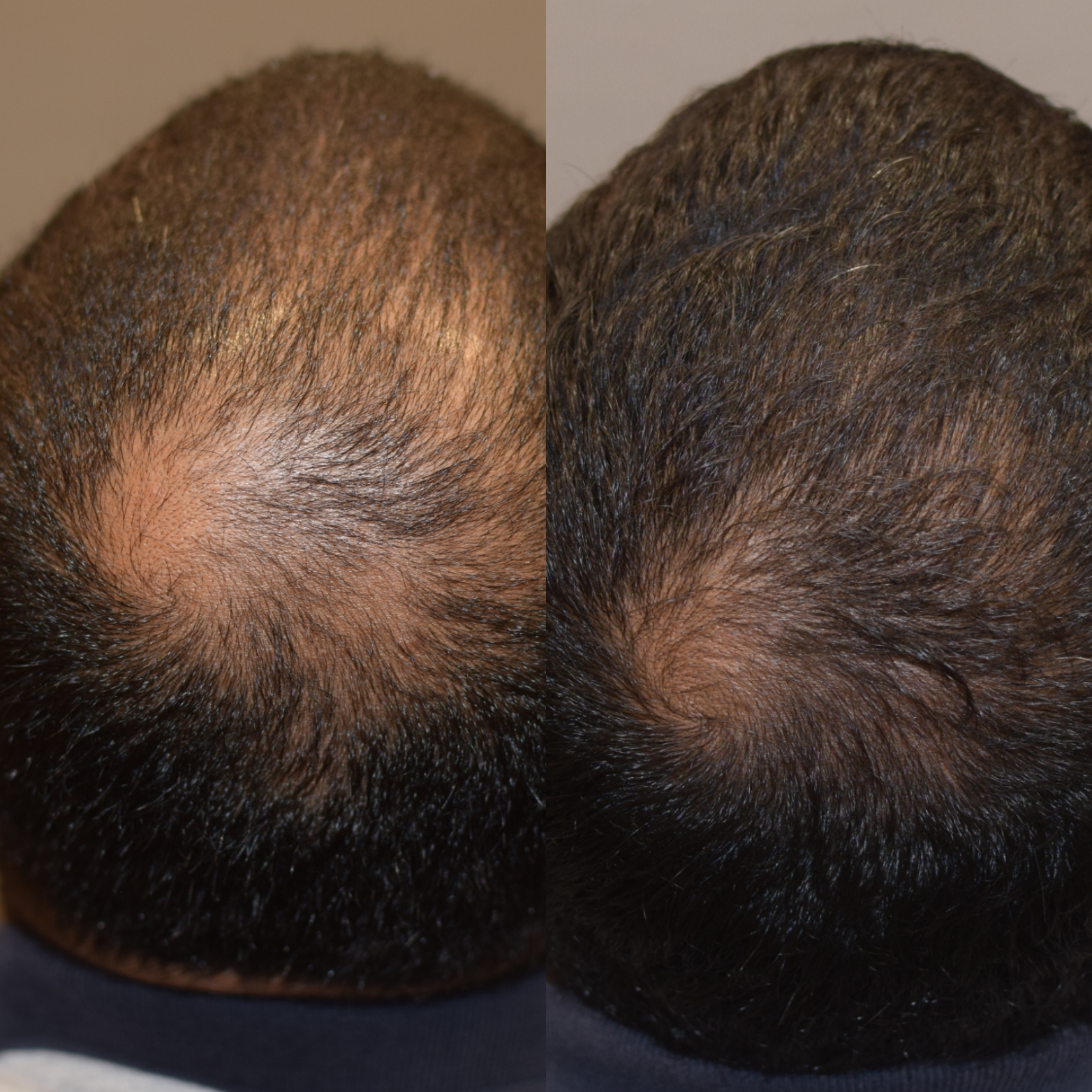 PRP hair loss treatment before and after at Kare Skin Health Center Santa Monica — before showing significant vertex crown thinning with scalp visible through hair in androgenetic alopecia pattern — after showing dramatically denser fuller hair coverage with scalp no longer visible and substantially increased hair density across the crown