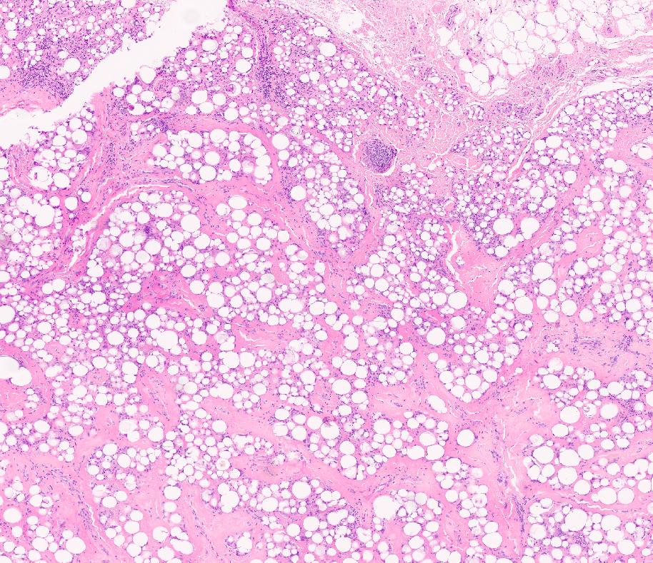 Histopathological biopsy specimen from Kare Plastic Surgery Los Angeles showing lipogranulomatous inflammation with large vacuolar spaces surrounded by histiocytes macrophages and multinucleated giant cells on hematoxylin and eosin stained tissue section confirming foreign body granuloma silicone granuloma diagnosis by Dr. Tiffany Sierro board-certified dermatologist