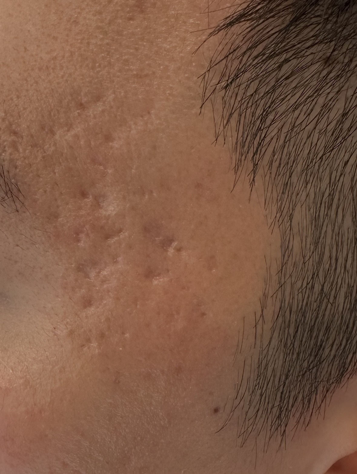 Ice pick and atrophic acne scars on the cheek of a male patient treated by Dr. Tiffany Sierro board-certified dermatologist at Kare Plastic Surgery Santa Monica showing classic pitted ice pick and depressed atrophic acne scar pattern with post inflammatory erythema on sun damaged skin presenting for TCA CROSS microneedling and CO2 laser acne scar treatment