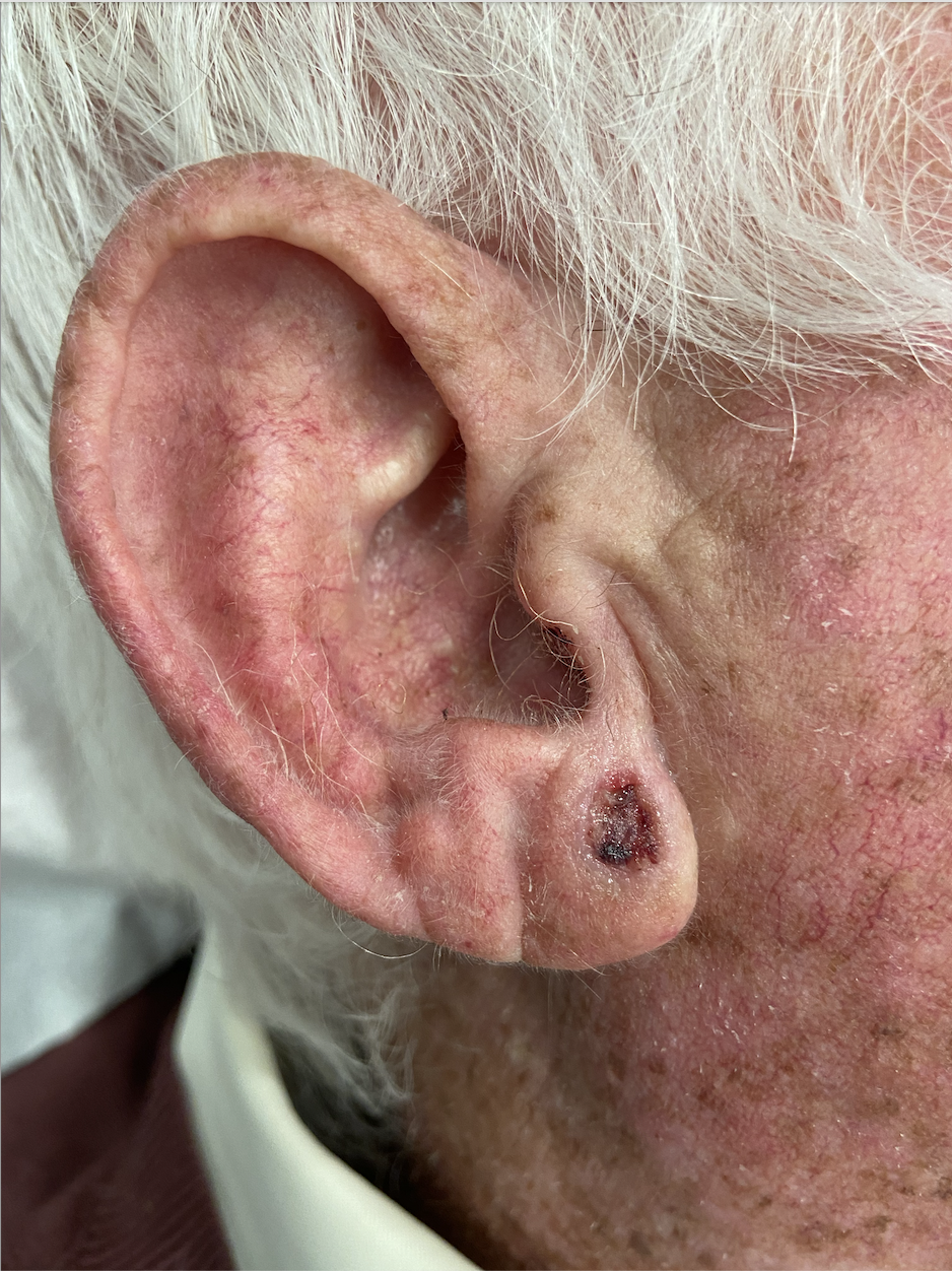 Squamous cell carcinoma of the earlobe before surgical excision at the Kare Skin Cancer Center Santa Monica by Dr. Tiffany Sierro board-certified dermatologist showing pigmented crusted lesion on inferior earlobe with irregular borders consistent with squamous cell carcinoma identified on dermoscopy and confirmed by skin biopsy