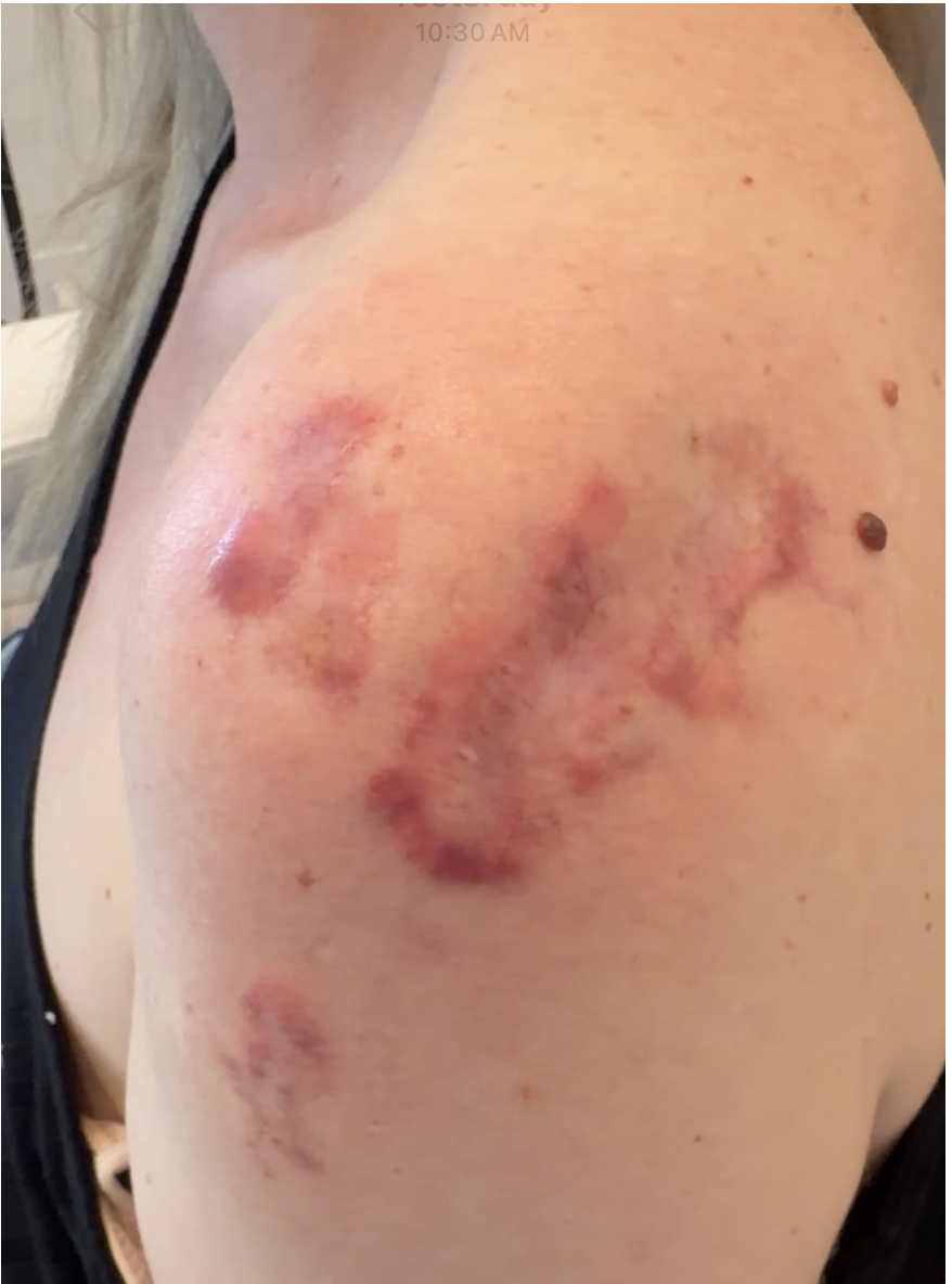 Large raised reddish brown shoulder keloid scar covering the upper arm and shoulder region treated at Kare Plastic Surgery