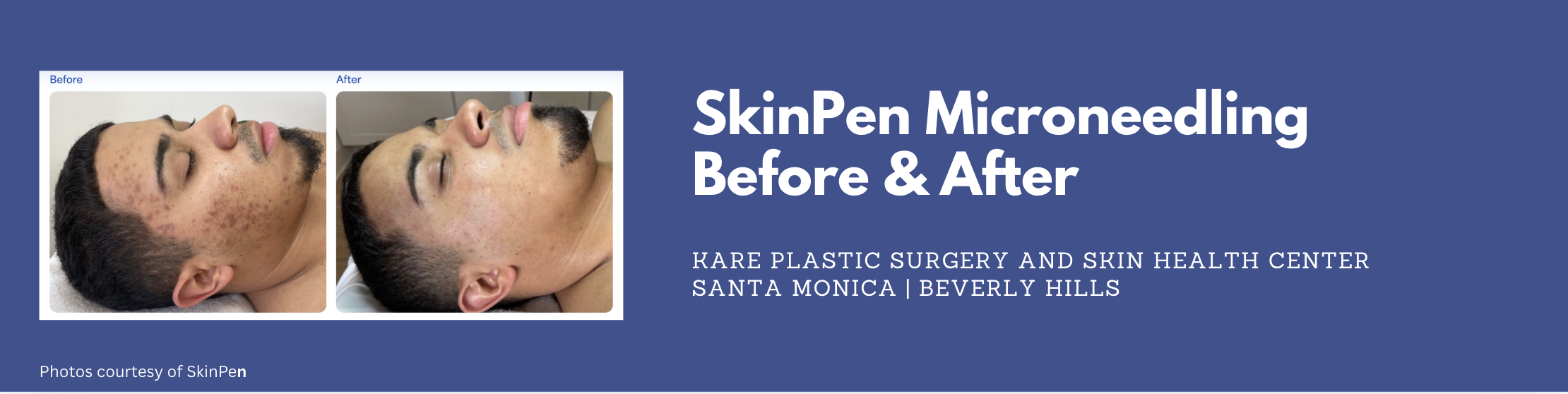 skinpen microneedling with dermatologist in santa monica
