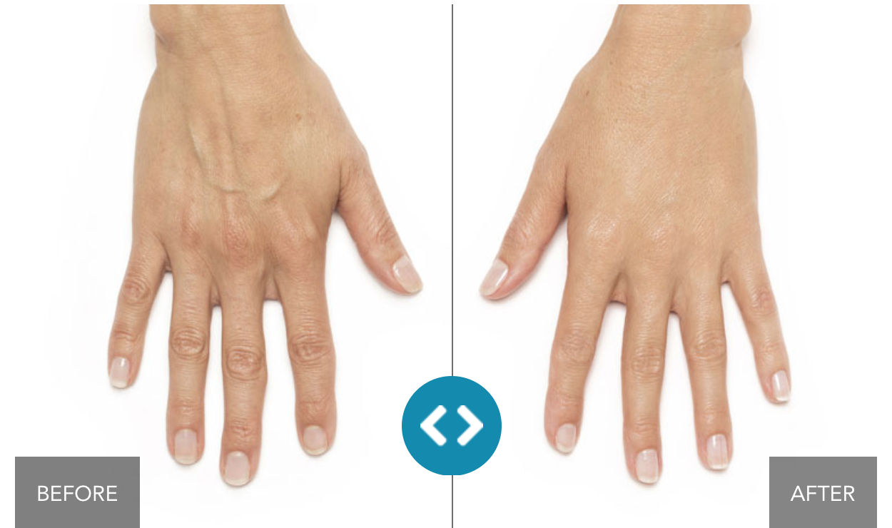 Radiesse Hand Rejuvenation in Santa Monica