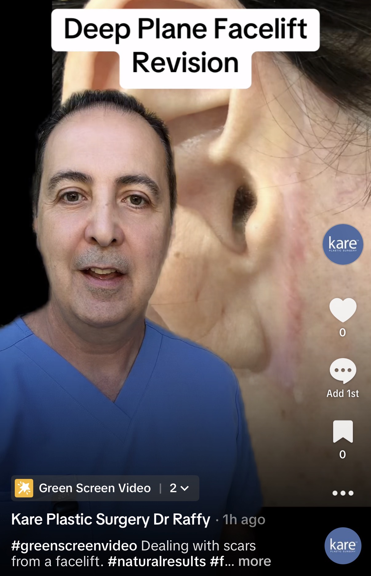 TikTok video from kareplasticsurgery showing Dr. Raffy Karamanoukian discussing deep plane facelift revision and facelift scar treatment, with a close-up image of the post-auricular facelift scar behind the ear demonstrating incision placement and early healing result